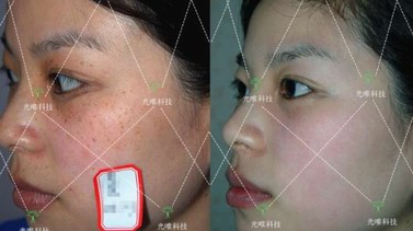 美白未來，科美顏SMB色素管理中心助你換新容顏。